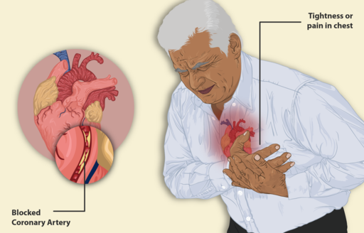 دليل مرئي لأزمة قلبية - A visual guide to a heart attack