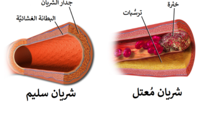 تصلب الشرايين - Arteriosclerosis