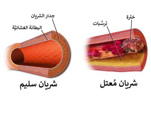 تصلب الشرايين - Arteriosclerosis