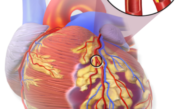 تصلب الشرايين - Atherosclerosis