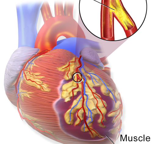 تصلب الشرايين - Atherosclerosis