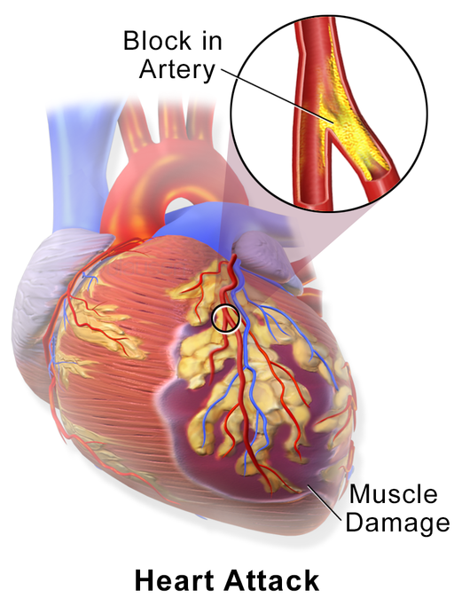 تصلب الشرايين - Atherosclerosis