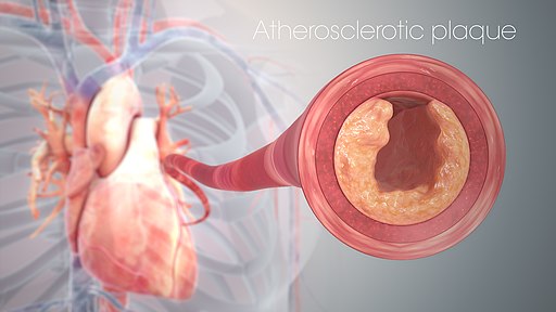 أمراض القلب والأوعية الدموية -Cardiovascular disease