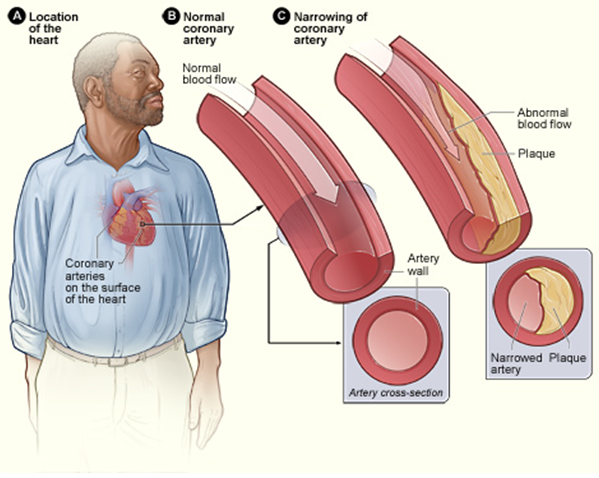 الرجال و امراض القلب - Men and heart disease