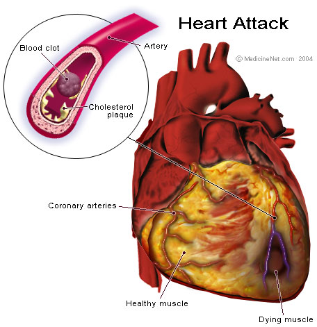 طرق للحد من مخاطر الإصابة بأمراض القلب - Ways to reduce the risk of heart disease