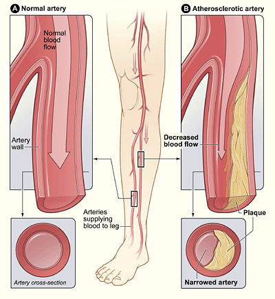 داء الشرايين المحيطية (peripheral artery disease