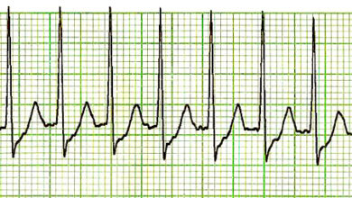 ما هي أنواع تسرع القلب فوق البطيني؟- What are the types of supraventricular tachycardia?