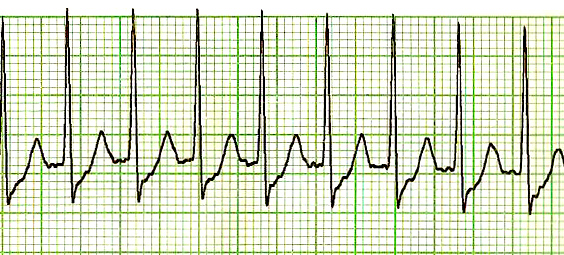 ما هي أنواع تسرع القلب فوق البطيني؟- What are the types of supraventricular tachycardia?