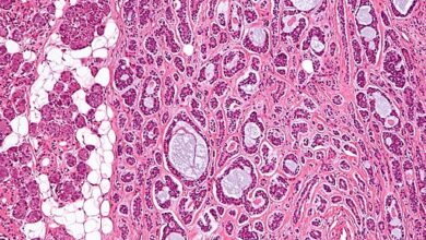 ما هو السرطان الغداني الكيسي؟ - What is adenoid cystic carcinoma?