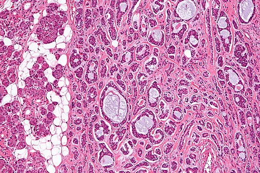 ما هو السرطان الغداني الكيسي؟ - What is adenoid cystic carcinoma?