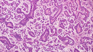 سرطان الغدانية الكيسية adenoid cystic carcinoma