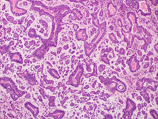 سرطان الغدانية الكيسية adenoid cystic carcinoma