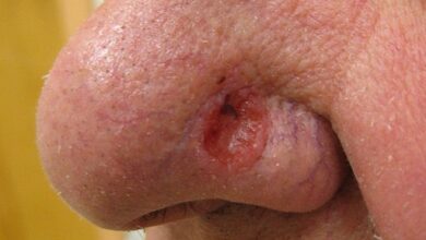 سرطان الخلايا القاعدية - Basal cell carcinoma