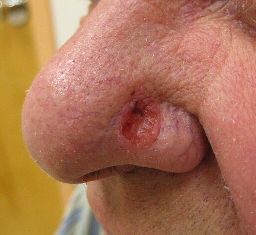 سرطان الخلايا القاعدية - Basal cell carcinoma