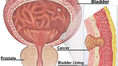 سرطان المثانة bladder cancer