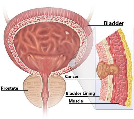 سرطان المثانة bladder cancer