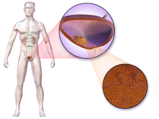 سرطان المثانة - bladder cancer