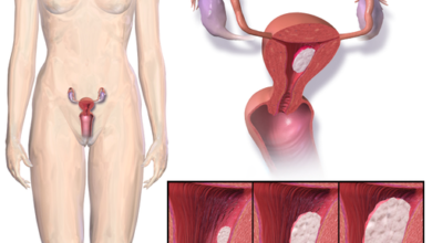 سرطان بطانة الرحم Endometrial cancer