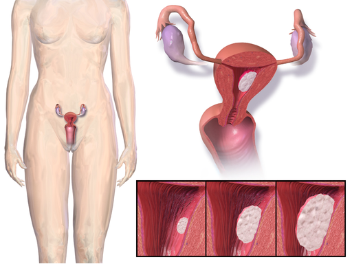 سرطان بطانة الرحم Endometrial cancer