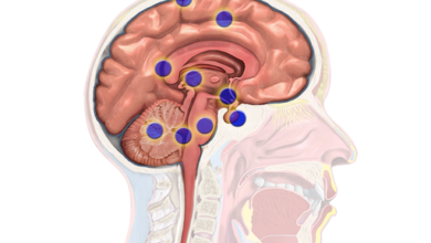 سرطان الدماغ brain cancer