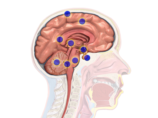 سرطان الدماغ brain cancer