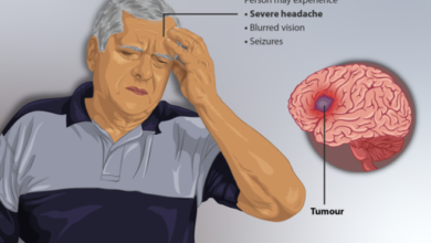 سرطان الدماغbrain cancer