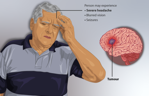 سرطان الدماغbrain cancer