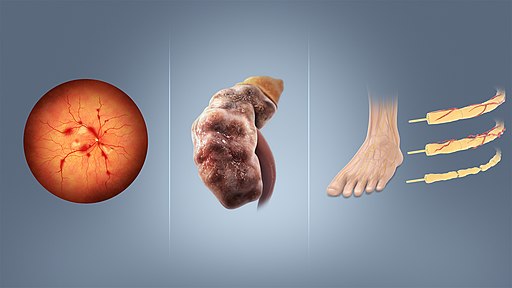 مضاعفات مرض السكري diabetes complication