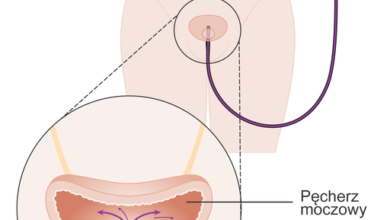 سرطان المثانة Bladder Cancer