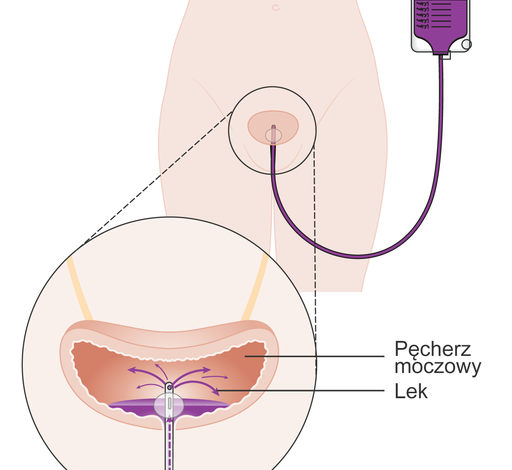 سرطان المثانة Bladder Cancer