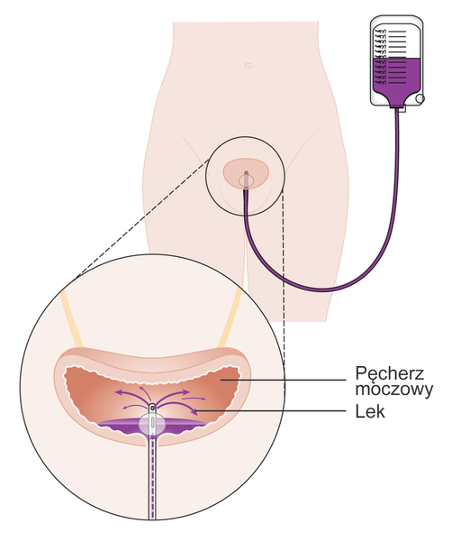 سرطان المثانة Bladder Cancer