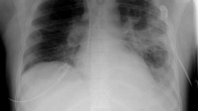 الالتهاب الرئوي Pneumonia