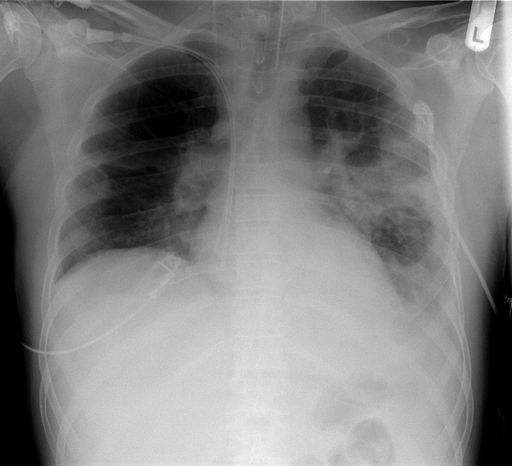 الالتهاب الرئوي Pneumonia