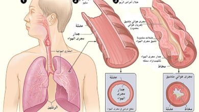 مرض الربو Asthma