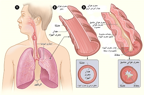 مرض الربو Asthma