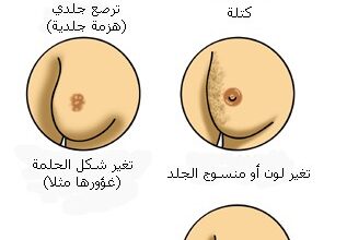 سرطان الثدي breast cancer