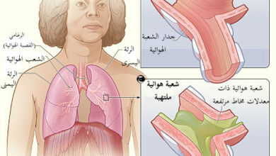 الإلتهاب الشعبي bronchitis