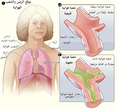 الإلتهاب الشعبي bronchitis