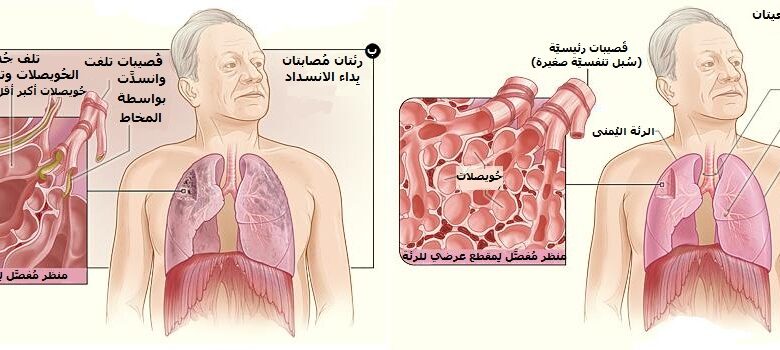 مرض الانسداد الرئوي المزمن chronic obstructive pulmonary disease