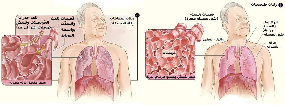 مرض الانسداد الرئوي المزمن chronic obstructive pulmonary disease