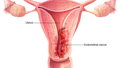 سرطان بطانة الرحم Endometrial cancer