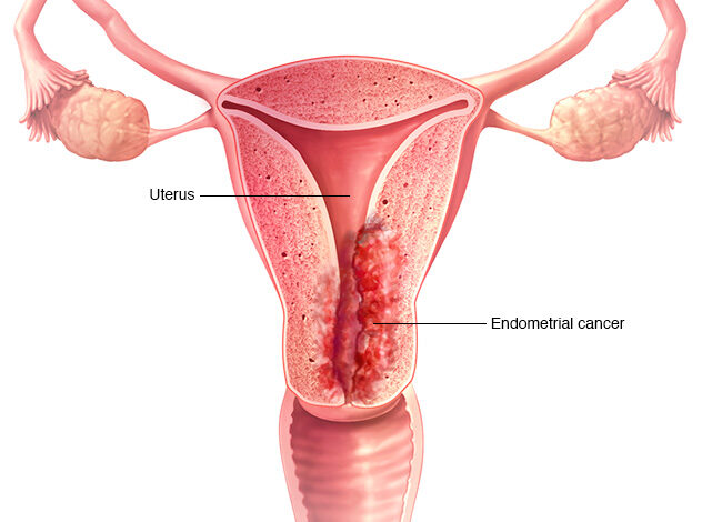 سرطان بطانة الرحم Endometrial cancer