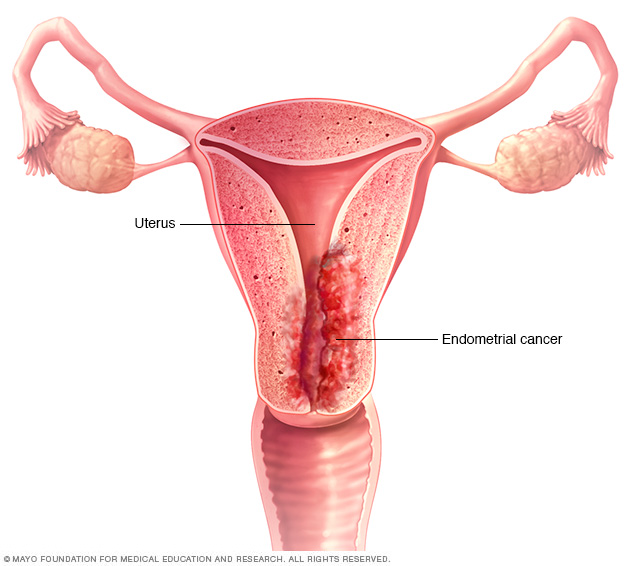 سرطان بطانة الرحم Endometrial cancer