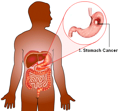 سرطان المعدة stomach cancer