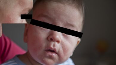 الحساسية عند الاطفال Allergy in children