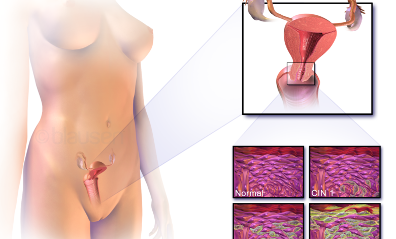 سرطان عنق الرحم (cervical cancer)