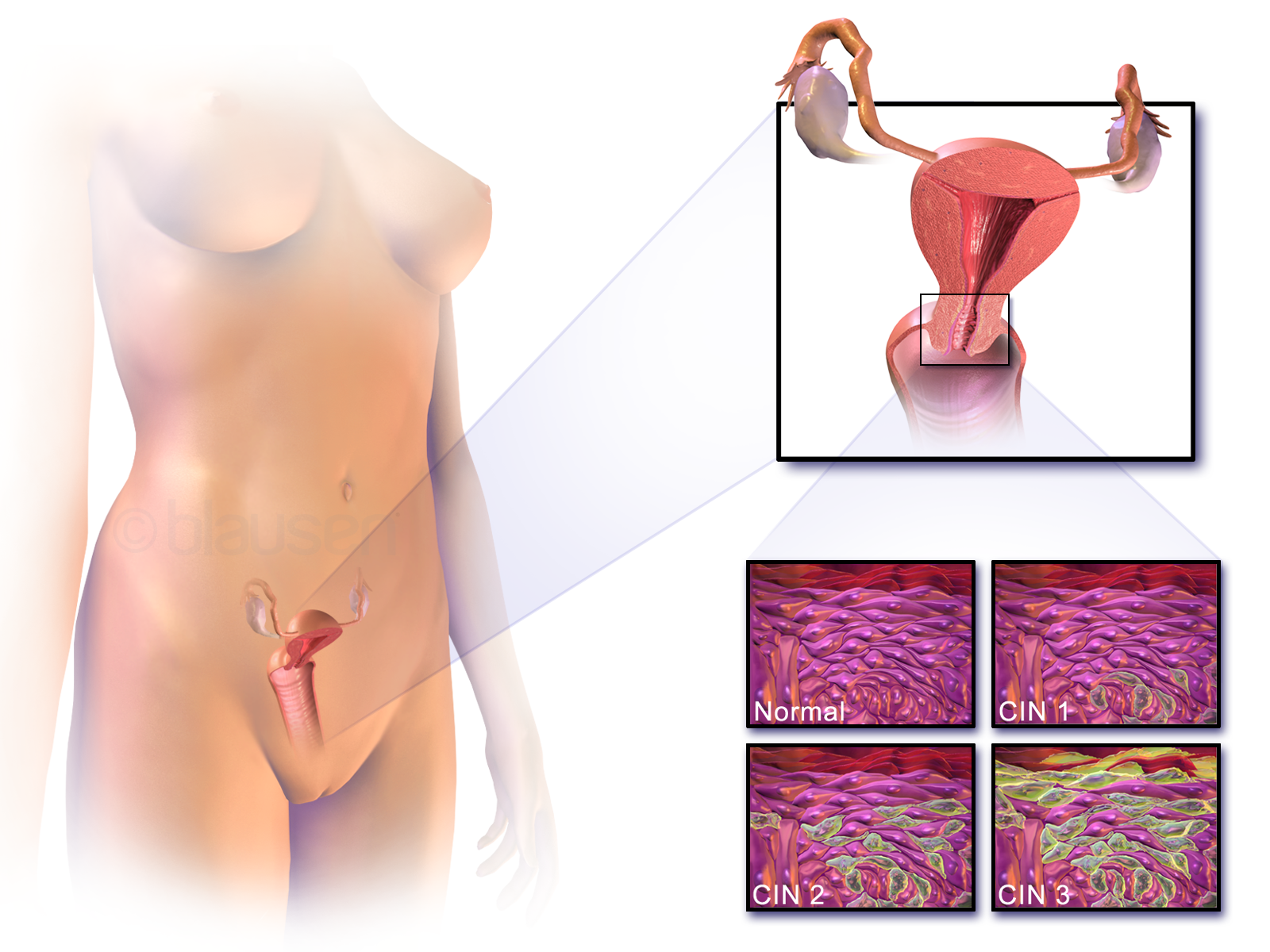 سرطان عنق الرحم (cervical cancer)