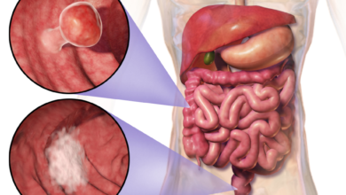 سرطان القولون والمستقيم(colorectal cancer)