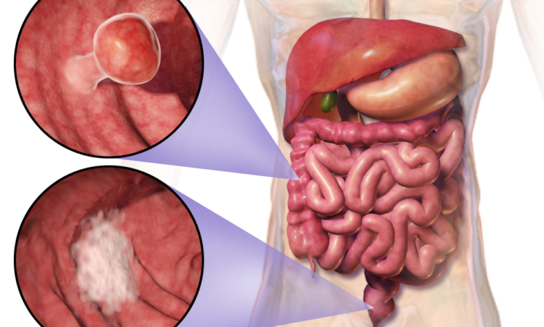 سرطان القولون والمستقيم(colorectal cancer)