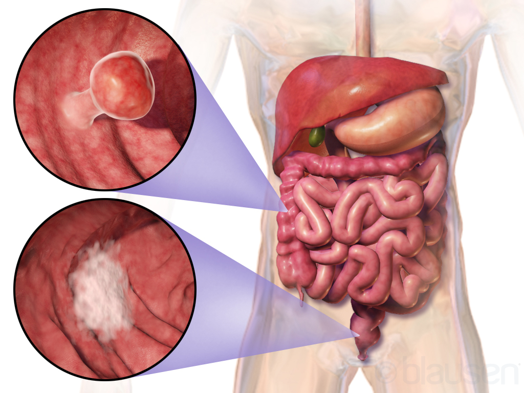 سرطان القولون والمستقيم(colorectal cancer)